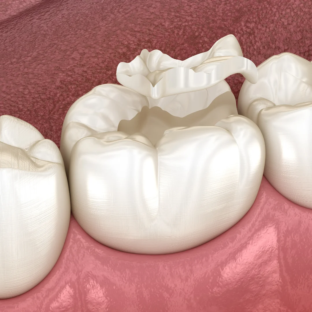 Cavity prevention and dental care at Glendale Dental Wellness